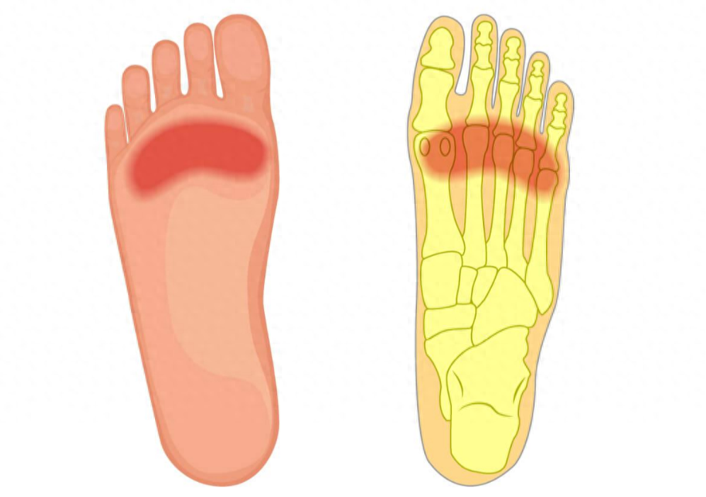 脚各个部位疼痛原因（详解不同位置脚疼原因）