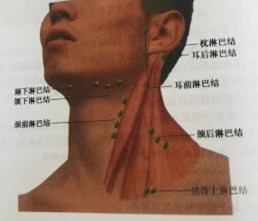 淋巴结肿大图片（教你自我判断肿大的淋巴结）