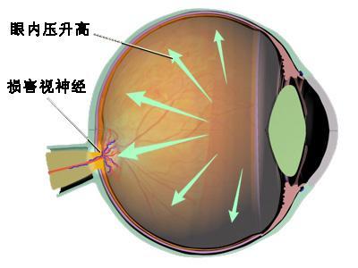 青光眼的症状和表现是什么（了解早期症状预防青光眼）