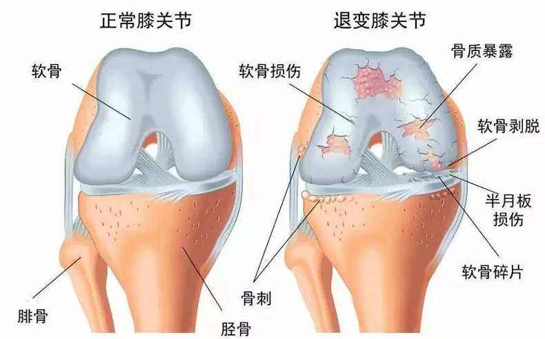 软骨症状有哪些症状（关节软骨损伤的症状和治疗方法）